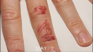 Timelapse Of A Wound Healing [upl. by Eenhpad]