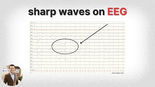 Learn EEG Positive Spikes and Sharps [upl. by Nnodnarb567]