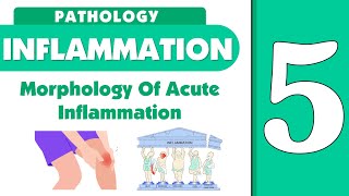 Inflammation lecture 5  morphology of acute inflammation [upl. by Studner386]