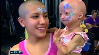 Adalia Rose holds fundraiser for Progeria [upl. by Tterraj114]