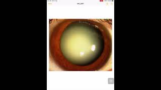 Immature cataract ophthalmology [upl. by Katharyn296]