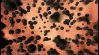 Hypersensitivity Pneumonitis [upl. by Mitchel]