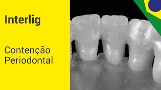 Interlig  Contenção Periodontal [upl. by Anehsat]