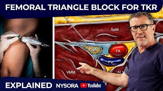 Femoral Triangle Block For TKR [upl. by Ailenroc]