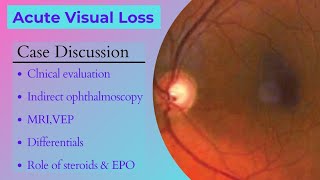 Case Discussion  Acute Visual Loss [upl. by Moira951]