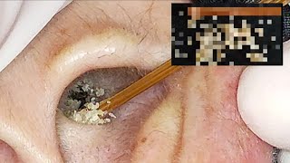 【耳掃除】84 耳かき 〜うそこんなに予想を超えた大大収穫〜 earwax [upl. by Hebbe]