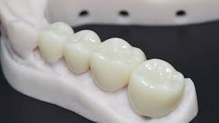 Types of Dental Crowns and Materials  Gold Porcelain Lithium Disilicate amp Zirconia [upl. by Loydie237]