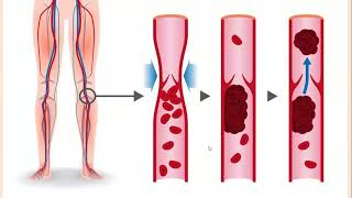 Lecture193 Varicose Veins DVT Superficial thrombophlebitis amp Venous Insufficiency Rook Ch 103 [upl. by Enairb906]