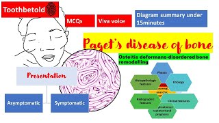 Pagets disease of bone  RadiographHISTOPATHOLOGYclinical features  NBDENEET MDSBDS  Diagrams [upl. by Ennaed]