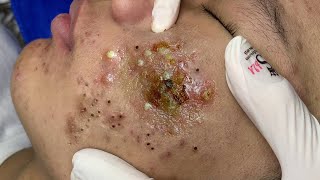 Big Cystic Acne Blackheads Extraction Blackheads amp Milia Whiteheads Removal Pimple Popping  9288 [upl. by Nnyltak]