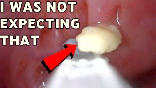 NOT EXPECTED Tonsil stone removal  AIM 6 [upl. by Hutchins]