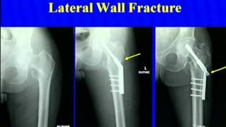 Peritrochanteric Fractures DHS Vs IM Nail [upl. by Forland547]