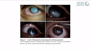 Corneal Hydrops Rethinking Treatment [upl. by Gnos]