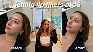 GETTING LIP FILLERS AT 18  before amp after [upl. by Sirois764]