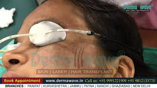 Nevus of Ota Treatment  Birthmark Removal by Laser  Panipat  Jammu  New Delhi  Patna Dermawave [upl. by Aderfla728]