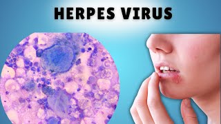 HERPES LABIAL E GENITAL [upl. by Fraya]