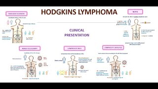 Types of Hodgkin lymphoma [upl. by Ntsyrk957]