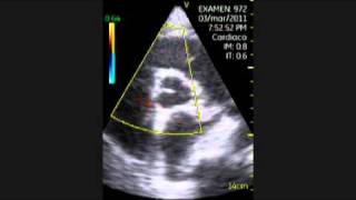 VSCAN Cardiomyopathy of Hypothyroidism Pocket ultrasound Cardiopatía en hipotiroidismo [upl. by Yelac]