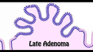 Animated Histology Colon Cancer Progression [upl. by Moonier]