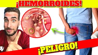 ¡FUE REVELADO SÍNTOMAS de ALARMA de HEMORROIDES CURAR HEMORROIDES de MANERA NATURAL [upl. by Assitruc]