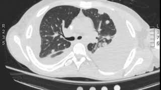 Endocarditis CT lung window JETem 2018 [upl. by Peck]