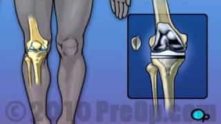 Knee Replacement Surgery PreOp® Patient Education [upl. by Walczak]