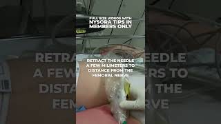 Secrets of Femoral Triangle and Adductor Canal Block [upl. by Shelton]