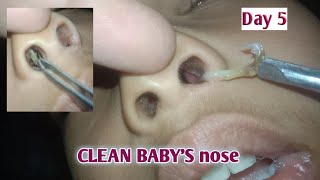 CLEAN BABYS nose day 5 [upl. by Grazia]