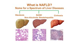 What is NonAlcoholic Fatty Liver Disease NAFLD [upl. by Ayaladnot447]