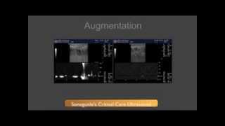 DVT Ultrasound Augmentation Technique [upl. by Esirahc530]