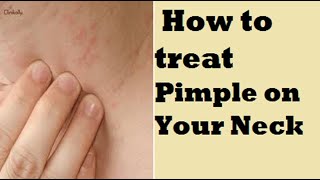 How to Treat a Pimple on Your Neck [upl. by Olli]