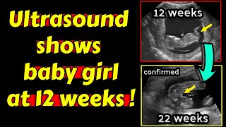 Ultrasound shows baby girl at 12 weeks pregnancy [upl. by Vani501]