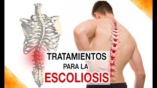 ¿Cuáles son los tratamientos para Escoliosis lumbar dorsal [upl. by Galina]