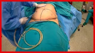 Liposuction Estetiği 2018 [upl. by Yralam525]