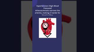 ATHEROSCLEROSIS nclex rn nursing nursingfoundation atherosclerosis healthawreness medical [upl. by Tanah]