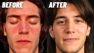 How I Cured My Seborrheic Dermatitis amp Dandruff [upl. by Dasya]