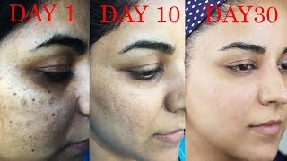 How I Got Rid of Dark Scars Hyperpigmentation PimplesAcne [upl. by Rodgers]