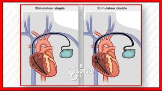 pleuropéricardite après implantation dun stimulateur cardiaque [upl. by Ecinnaj]