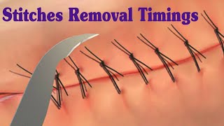 SUTURE REMOVAL TIMINGS  Stitches Removel Timings [upl. by Conley81]