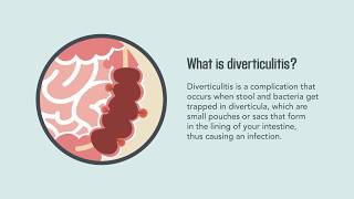 Diverticulitis Signs Symptoms Causes and Treatment  Merck Manual Consumer Version Quick Facts [upl. by Nemra]