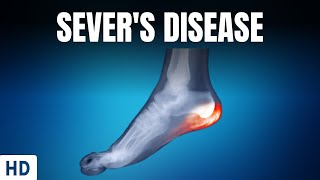 Severs Disease  Everything you need to know [upl. by Ocsicnarf275]