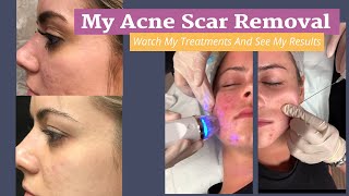 My Acne Scar Removal Journey RF Microneedling with PRP Treatments and Results [upl. by Nytram]