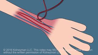 Dialysis Fistula animation [upl. by Pilif546]