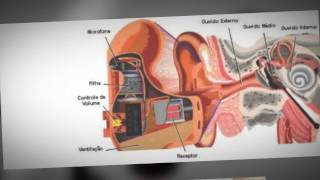Conserto e Manutenção de Aparelho de Surdez  Audição em Foco [upl. by Enirahtak]