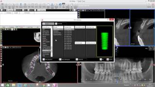 Implant Placement with Bone Density Assessment  XMind Trium [upl. by Asereht222]