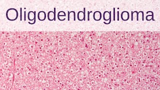 Oligodendroglioma  Pathology mini tutorial [upl. by Ingeborg]