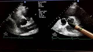 Valvula aortica Aorta bivalva Ecocardiograma Cardiologia Puerto Vallarta [upl. by Hewart]