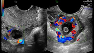 CORPUS LUTEUM VS ECTOPIC PREGNANCY [upl. by Barrie555]