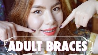 ADULT BRACES HUGE Overbite Experience amp QA [upl. by Nithsa457]