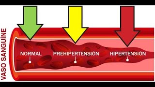 Hipertensión Arterial [upl. by Ddene]